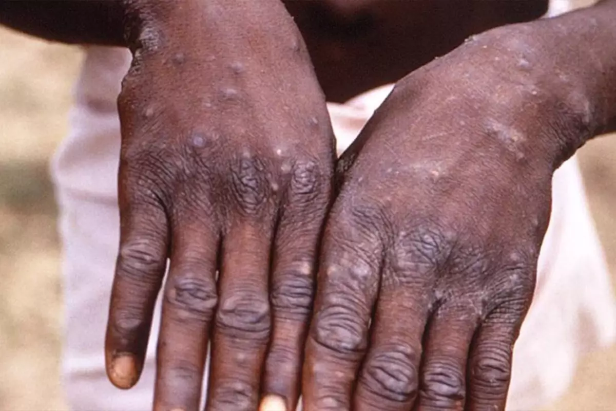 Uganda’da M Çiçeği salgınında can kaybı sayısı 37’ye yükseldi